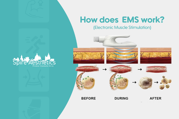 EMS treatment for post pregnancy weight loss treatment Earls Barton