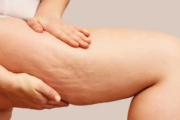 Image of woman showing leg with cellulite Earls Barton