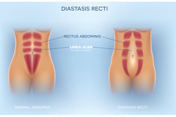 What Non-Surgical Options Are Available for Diastasis Recti Earls Barton?