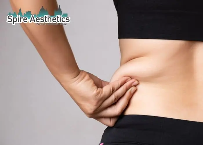 Image of woman pinching fat on their hips Earls Barton. Fat Freezing treatment