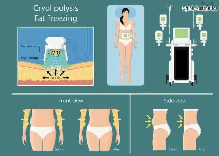Fat freezing treatment Earls Barton benefits for competitions to remove stubborn fat deposits.