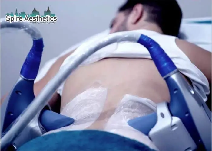 Man having fat freezing treatment done on love handles before a competitions Earls Barton to create a sculpted look.