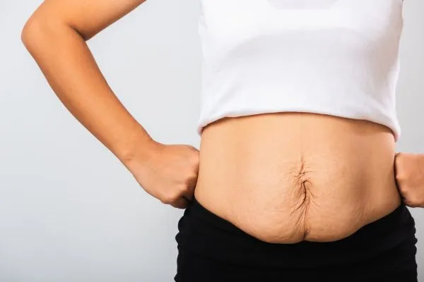 Image of a woman's stomach after weight loss with sagging skin following a gastric band Earls Barton