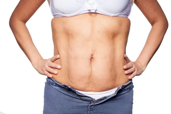 sagging skin on woman's stomach after weight loss injections Earls Barton