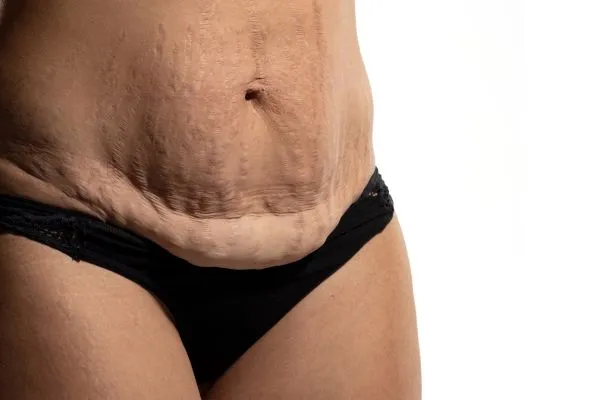 Image of womans stomach after weight loss injections Earls Barton showing saggy skin