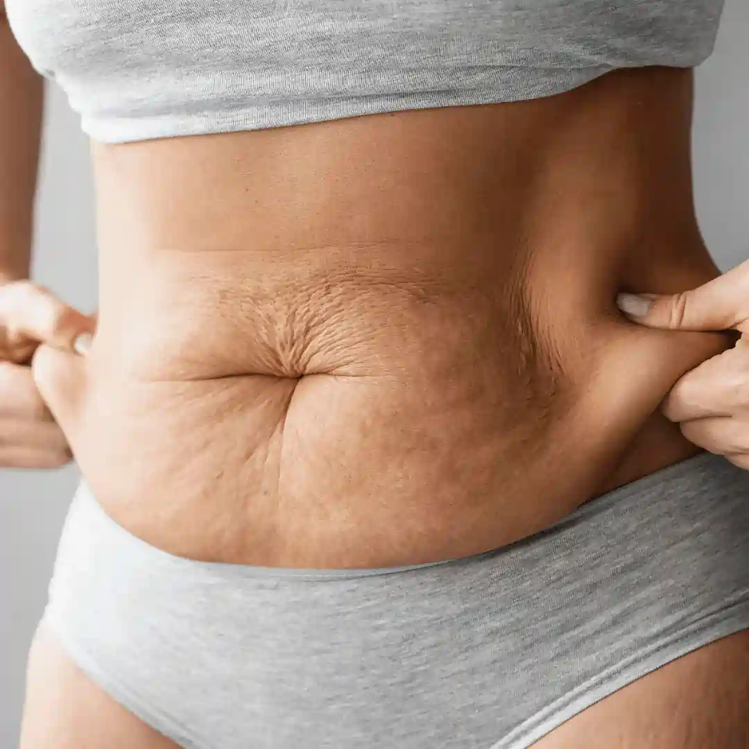 Is It Normal to Have Loose Skin After Pregnancy Earls Barton?