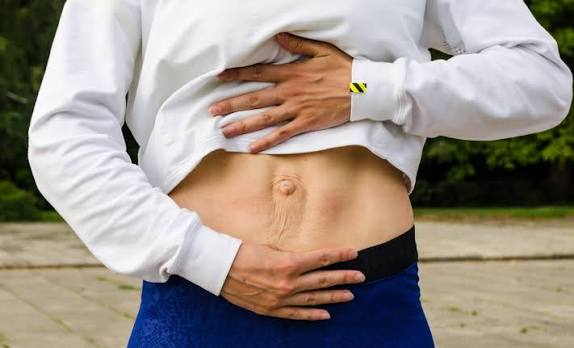 When Could Diastasis Recti Be the Missing Piece of the Puzzle Earls Barton?