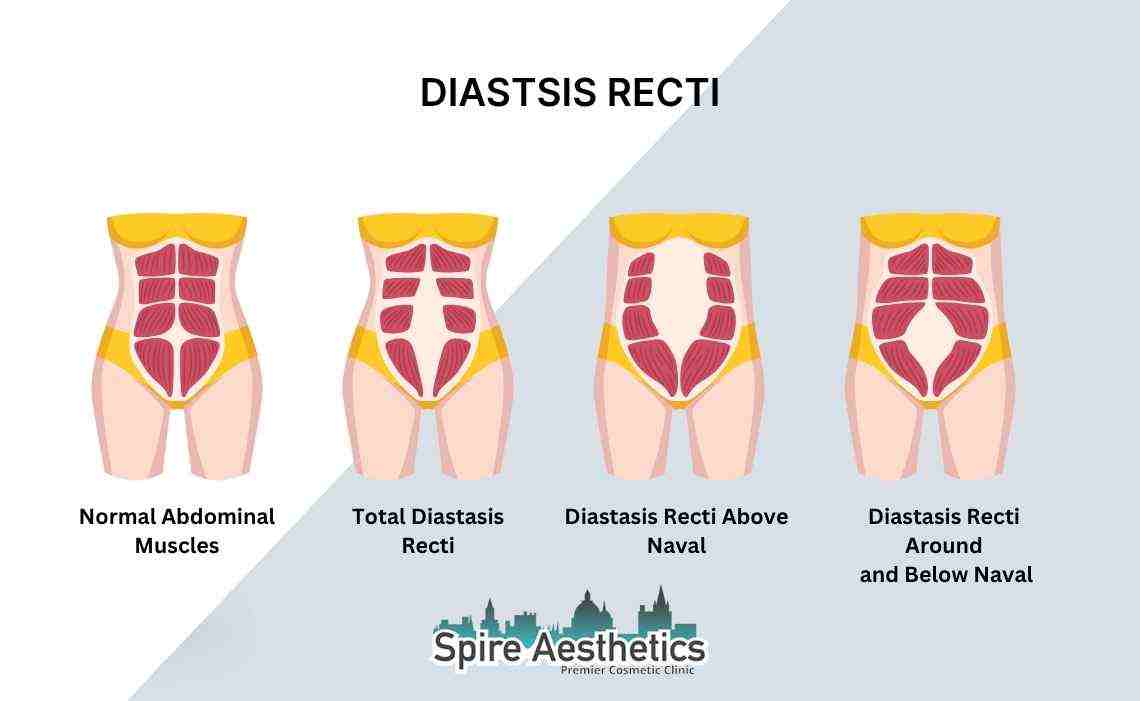 Is Non-Surgical Diastasis Recti Treatment Right for You? Common Concerns Answered Earls Barton